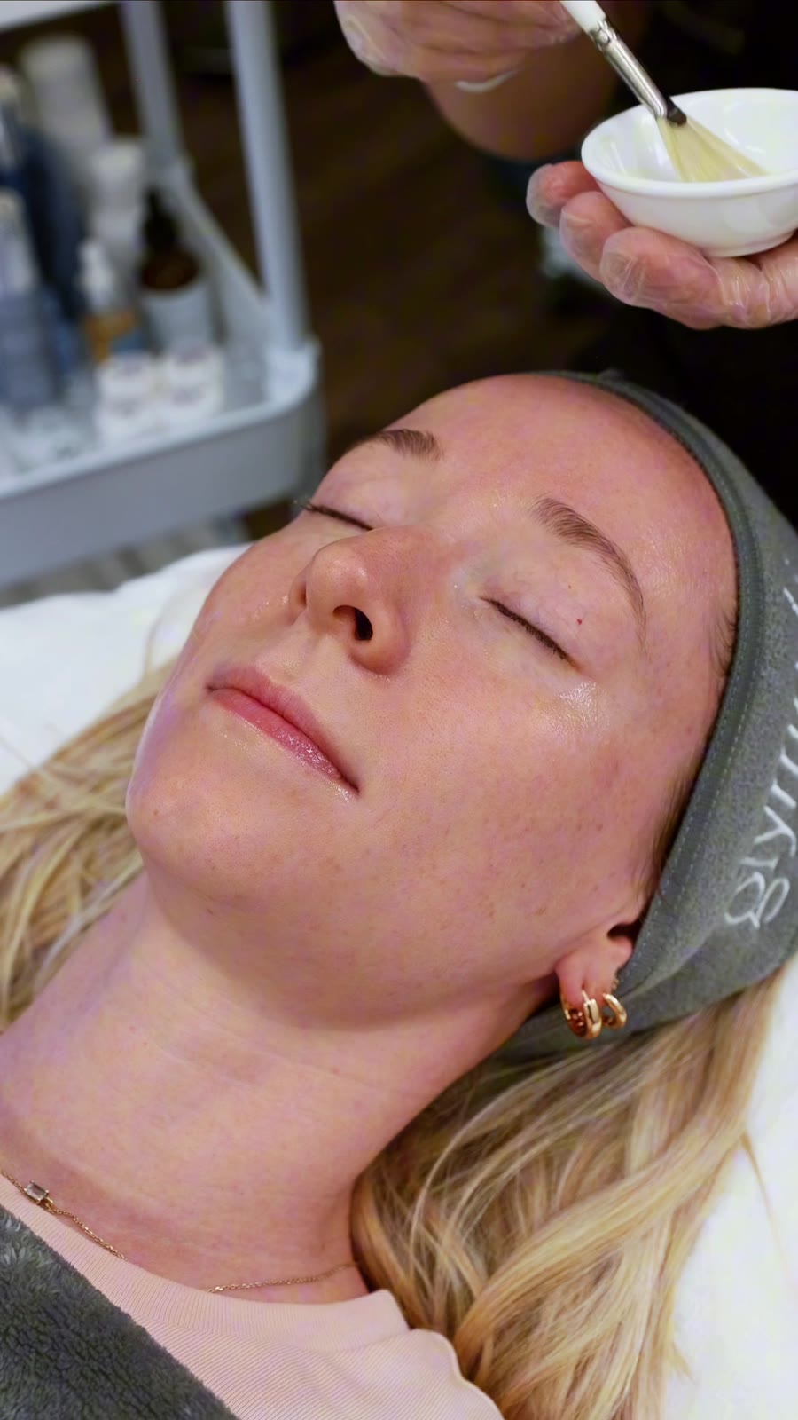 chemical-peel-treatment-calgary