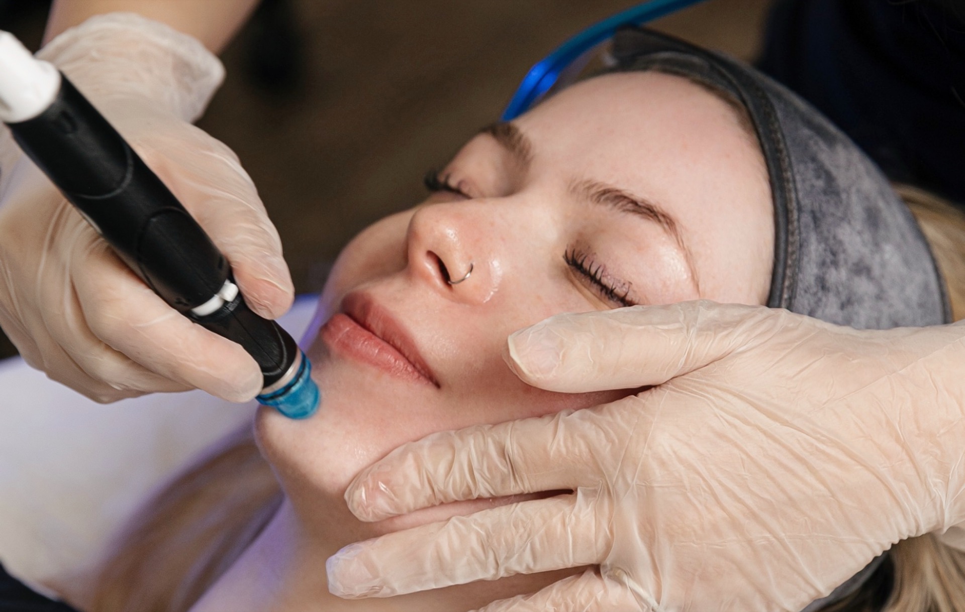 HydraFacial treatment closeup at Ageless Esthetics Calgary