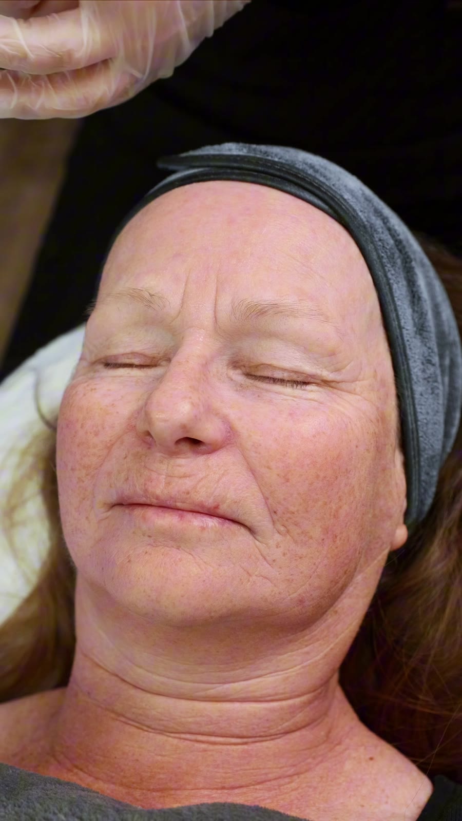 microneedling-client-calgary