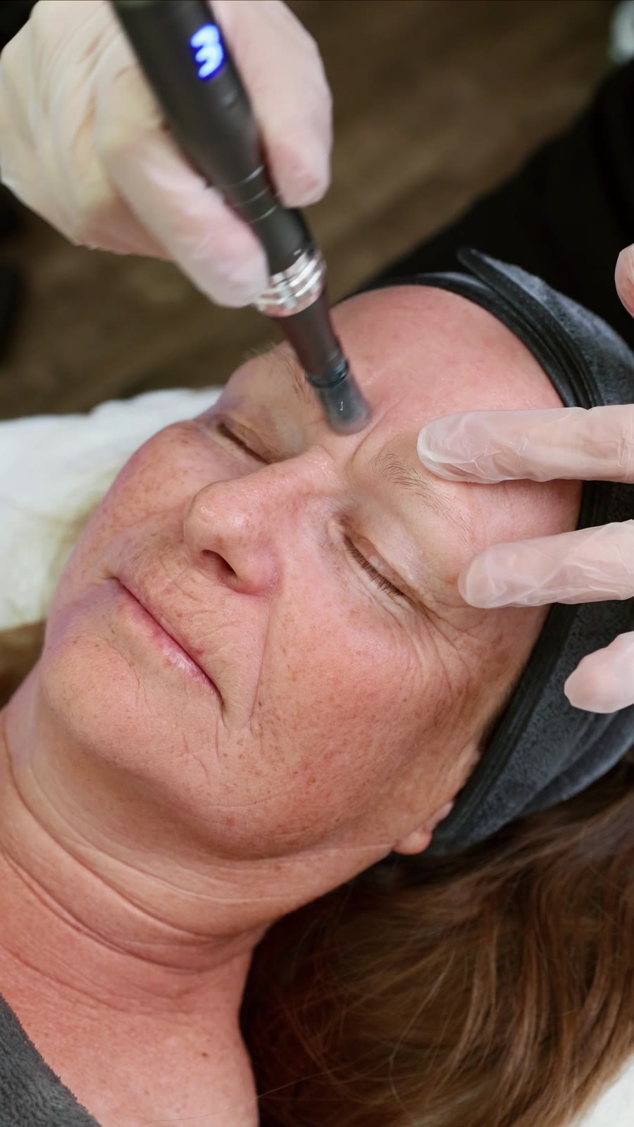 microneedling-treatment-calgary